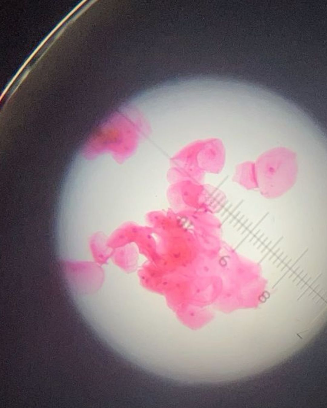 Lymphocyte Immunization Therapy    (LIT)